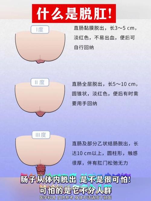 怎么判断自己脱肛了